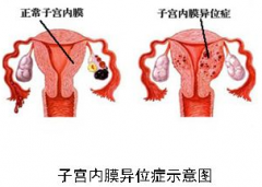 图解丨专家带你全面了解“子宫内膜异位症”